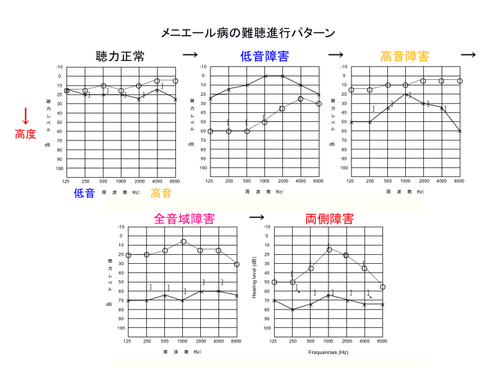 メニエール病の難聴進行パターン