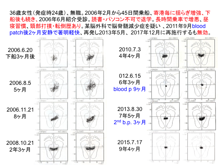 症例：36歳女性（発症時24歳）、無職