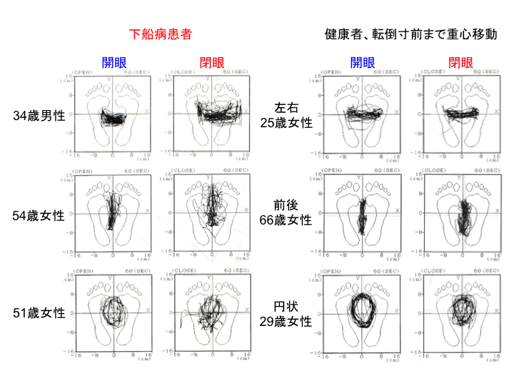 下船病患者の重心動揺記録